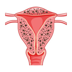 Diffuse Adenomyosis Human anatomy Female reproductive Sick system organs location scheme, uterus vagina icon vector medical Cross section Realistic flat illustration isolated on white background
