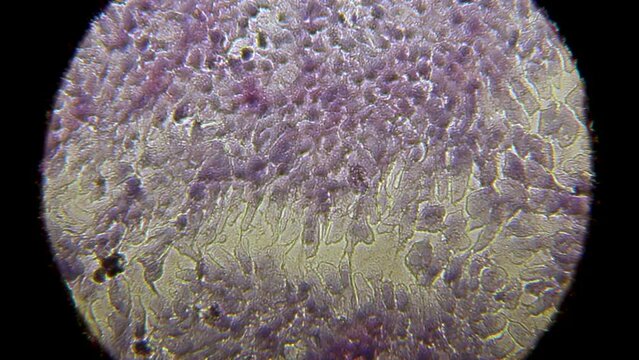 Microscopic view of human cancer cells, use for a scientific study of antitumor activity