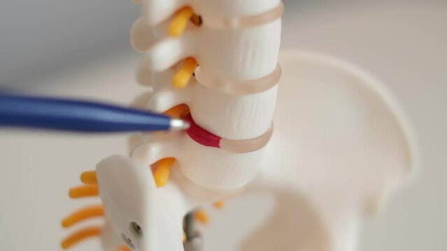 Intervertebral hernia of the cervical spine, rupture of the fibrous ring. Osteochondrosis, copy space. Human column plastic model complete pan at physiotherapy clinic