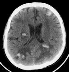 hemorrhagic brain metastases, head ct scan 
