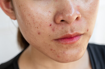 Cropped shot of woman having problems of acne inflamed on her face. Inflamed acne consists of...