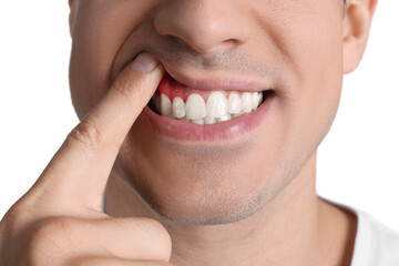 Fototapeta premium Man showing inflamed gums on white background, closeup