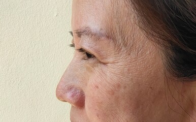 Portrait showing flabbiness and wrinkled skin beside the face, problem ptosis on the eyelid of the woman, concept health care.