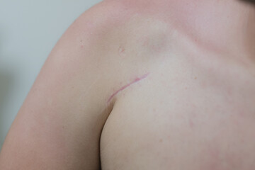 Fototapeta premium scar on a person's chest