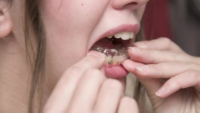 Mouth close-up A young woman puts a corrective aligner splint on her lower teeth to correct an overbite while looking in the bathroom mirror. Installation of aligners