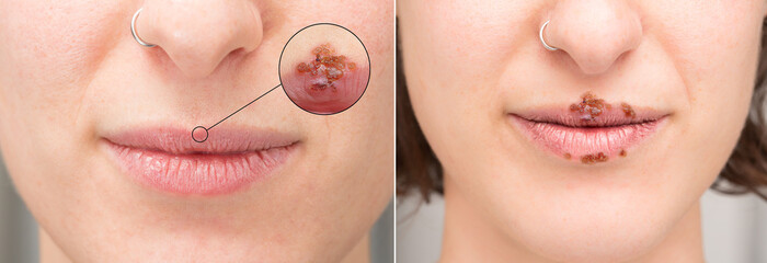 Closeup of female lips with pustules and crusts of Herpes Simplex