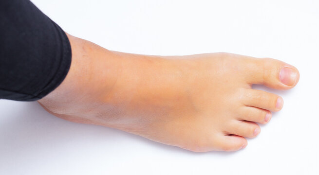 Right foot of young female patient undergoing podiatry check up