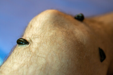 Treatment with hirudotherapy. Leeches on a man's hairy leg. An unconventional method of treating...