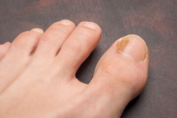 Toenails with fungus problems,Onychomycosis, also known as tinea unguium, is a fungal infection of...