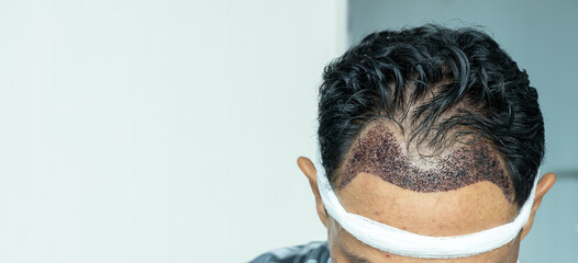 Man head with hair transplant surgery with receding hair line, FUE, Follicular unit extraction, Types of hair transplant procedures and their stages. Male alopecia treatment.