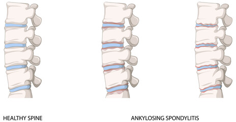 Infographic of healthy spine and ankylosing spondylitis - obrazy, fototapety, plakaty