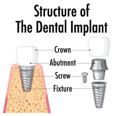 Infographic of human in structure of the dental implant