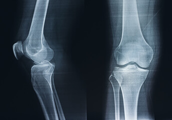 Film X-ray of a leg bone person