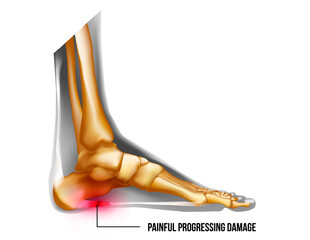 Foot pain, plantar fasciitis inflammation and ruptures strain realistic anatomy illustration