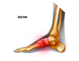 Arch of foot pain bones skeleton realistic anatomy illustration