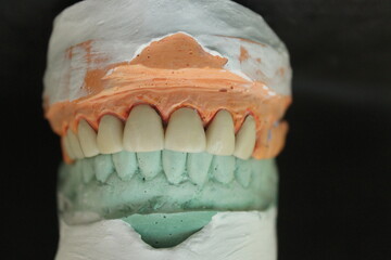 Obraz premium Dentures made of non-precious material and then baked with porcelain before the dentist puts them on the patient.