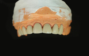 Dentures made of non-precious material and then baked with porcelain before the dentist puts them on the patient.
