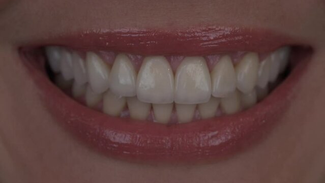 smile girl with upper jaw veneers smiles and shows different emotions