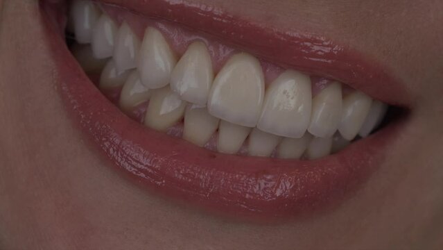 bright smile of a girl with veneers smiling