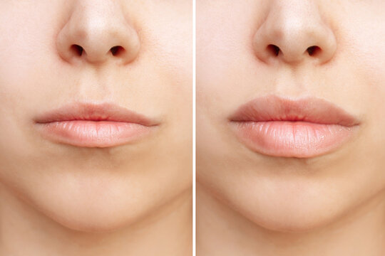 Result of lip augmentation. Cropped shot of young woman's lower part of face with lips before and after lip enhancement. Injection of filler in lips