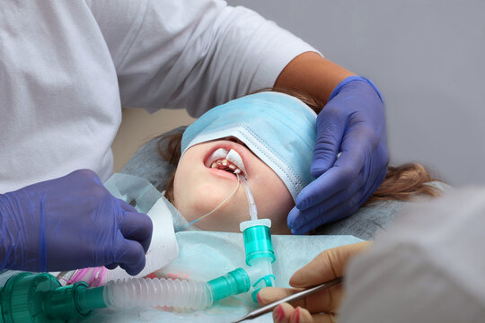 Treatment of baby teeth under anesthesia. The child is undergoing surgery. Open mouth. Baby teeth.