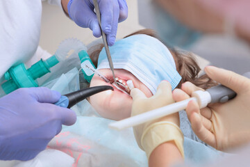 Treatment of caries of baby teeth under general anesthesia. Breathing tube.The doctor's hands are...