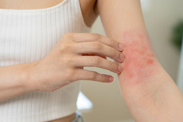 Dermatology, asian young woman, girl hand in her arm allergy, allergic reaction from atopic, insect...