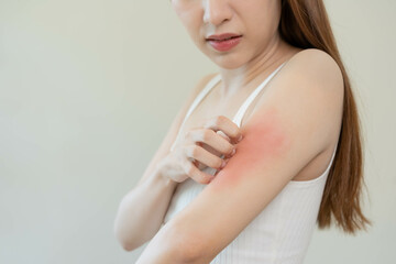 Dermatology, asian young woman, girl hand in her arm allergy, allergic reaction from atopic, insect bites, hand in scratching itchy, itch red spot or rash of skin. Beauty problem by medical treatment.