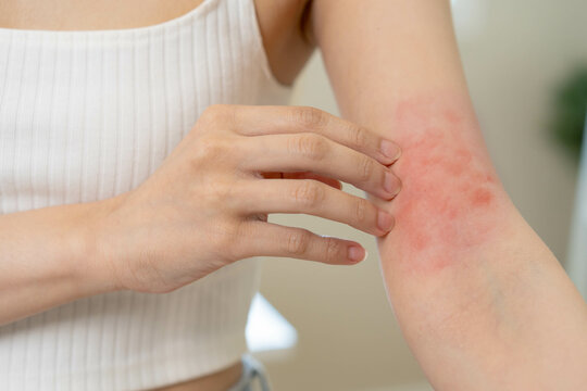 Dermatology, asian young woman, girl hand in her arm allergy, allergic reaction from atopic, insect bites, hand in scratching itchy, itch red spot or rash of skin. Beauty problem by medical treatment.