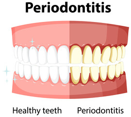 Infographic of human in periodontitis