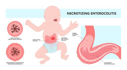 ileus bowel toxic small midgut cecal colon tract Hirschsprung's gastric Ladd band large hiatal hernia cancer tumor swollen crohn's x-ray meckel's twist blocked birth defect infant children pain short