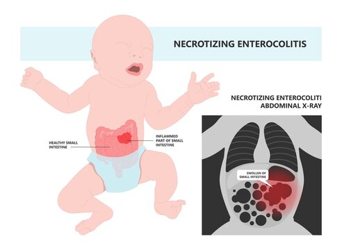 ileus bowel toxic small midgut cecal colon tract Hirschsprung's gastric Ladd band large hiatal hernia cancer tumor swollen crohn's x-ray meckel's twist blocked birth defect infant children pain short