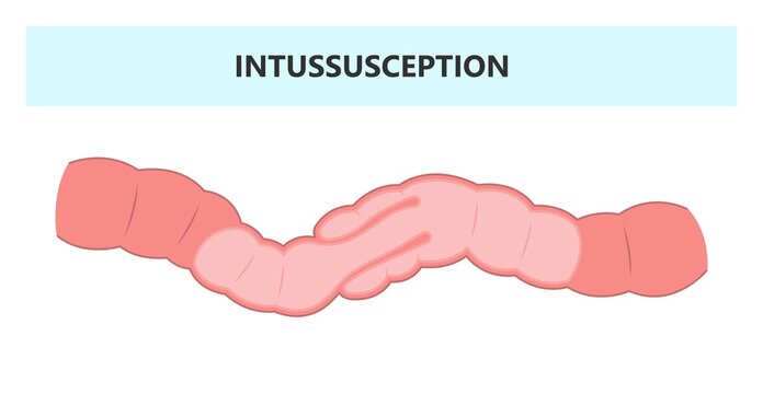 ileus bowel toxic small midgut cecal colon tract Hirschsprung's gastric Ladd band large hiatal hernia cancer tumor swollen crohn's x-ray meckel's twist blocked birth defect infant children pain short
