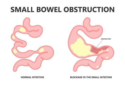 Ileus Bowel Toxic Small Midgut Cecal Colon Tract Hirschsprung's Gastric Ladd Band Large Hiatal Hernia Cancer Tumor Swollen Crohn's X-ray Meckel's Twist Blocked Birth Defect Infant Children Pain Short