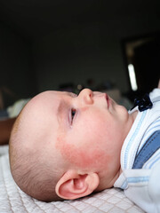 Atopic dermatitis child skin problem