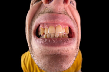Man showing his brown teeth