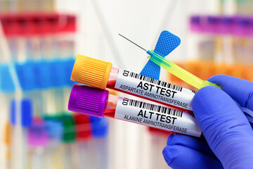 doctor with Blood tubes and needle for AST Aspartate aminotransferase and ALT alanine aminotransferase test in lab. Blood samples of patient for AST and ALT test in laboratory