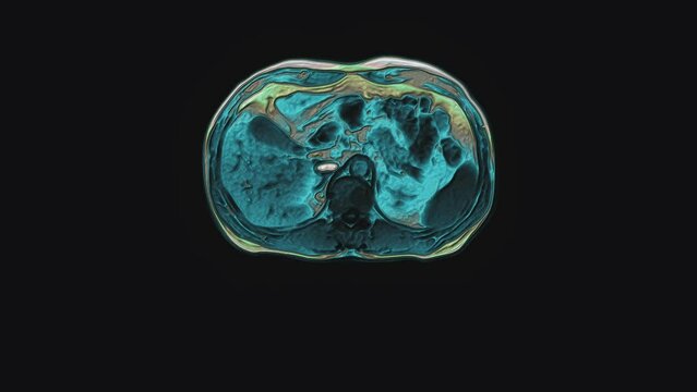 Bulk multicolored CT scan of the abdomen. Computed tomography of the gastrointestinal tract, liver and kidneys