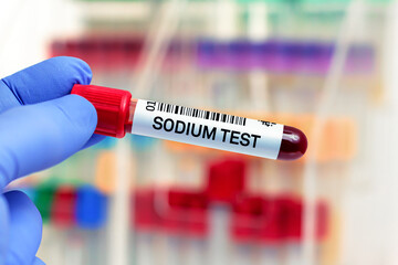 doctor with Blood tube for Sodium test in lab. Blood sample of patient for Sodium test in laboratory