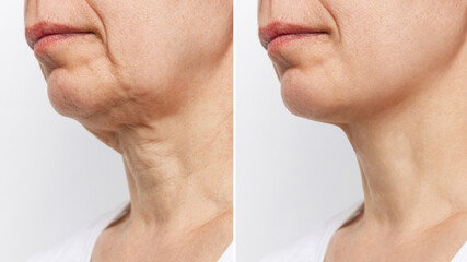 Lower part of the face and neck of elderly woman with signs of skin aging before and after...