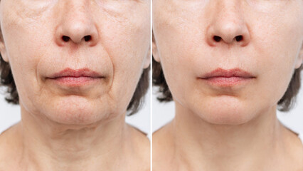 Lower part of face and neck of elderly woman with signs of skin aging before after facelift, plastic surgery on white background. Age-related changes, flabby sagging skin, wrinkles, creases, puffiness - obrazy, fototapety, plakaty