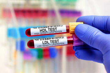 doctor with Blood tubes for HDL High Density Lipoprotein and LDL Low Density Lipoprotein test. Blood samples of patient for High Density Lipoprotein HDL and  Low Density Lipoprotein LDL test in lab - obrazy, fototapety, plakaty