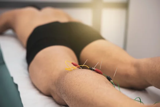 electroacupuncture with the needle connection machine used by the  acupuncturist in men. Electrical stimulation in physiotherapy to the twin  of a young man in the physiotherapy center. Stock Photo