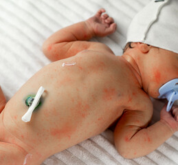 diaper rash in babies and care for them from the first days of birth