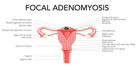 Focal Adenomyosis with inscriptions, Human anatomy Female reproductive Sick system organs. Structure of uterus, cervix, ovary, fallopian tube in Latin text. Frontal view in a cut Vector illustration - obrazy, fototapety, plakaty
