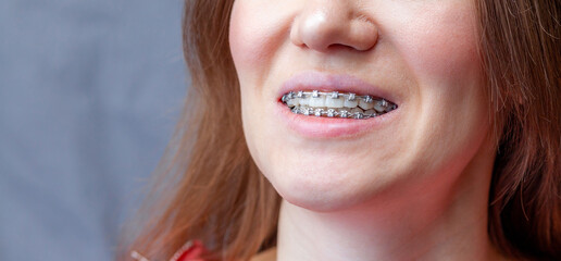 The smile of a young and beautiful girl with braces on her white teeth. Straightening of crooked...
