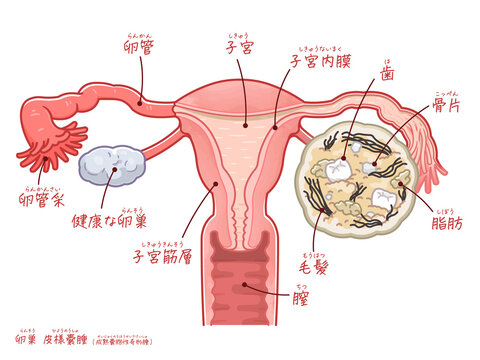 卵巣嚢腫・皮様嚢腫・奇形腫のイラスト（テキスト付き）