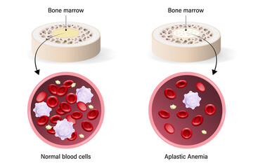 Aplastic anemia. The difference between normal blood and aplastic anemia. Red blood cells, White blood cells and platelets.