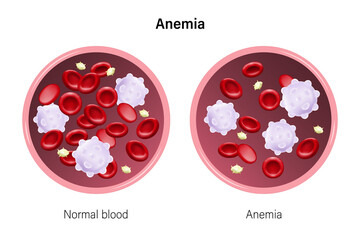 Anemia. The difference of Anemia amount of red blood cell and normal. Red blood cells, White blood cells and platelets. - obrazy, fototapety, plakaty