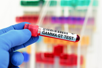 doctor with Blood tube for Gamma GT GGT test in biochemistry lab. Blood sample of patient for Gamma...